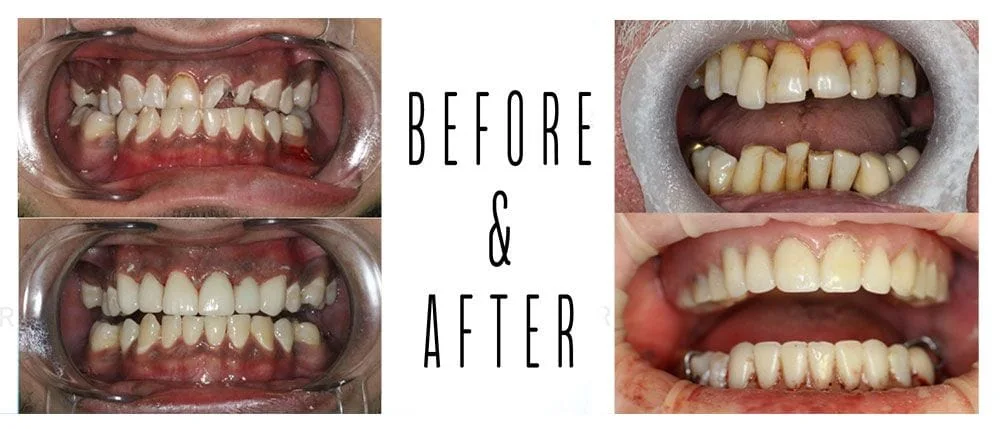 Before and After cosmetic dentistry Cedar Park