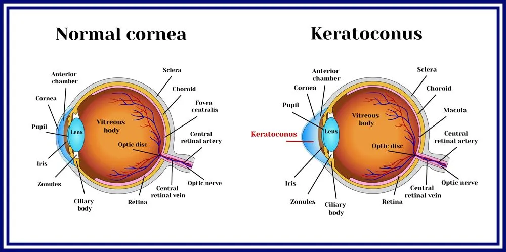 Keratoconus