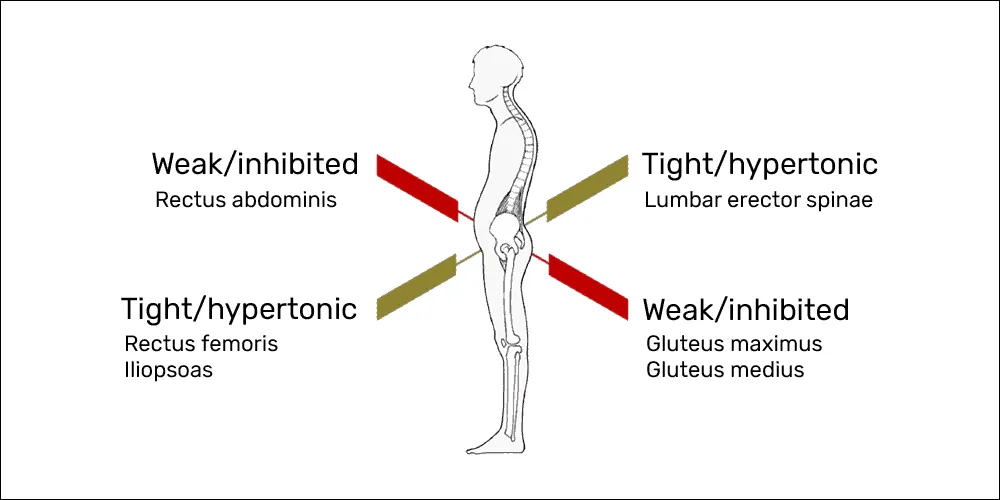 lower crossed syndrome sheboygan wi