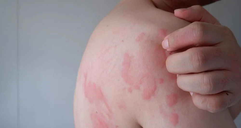 Woman looking in her arms with hives and redness.