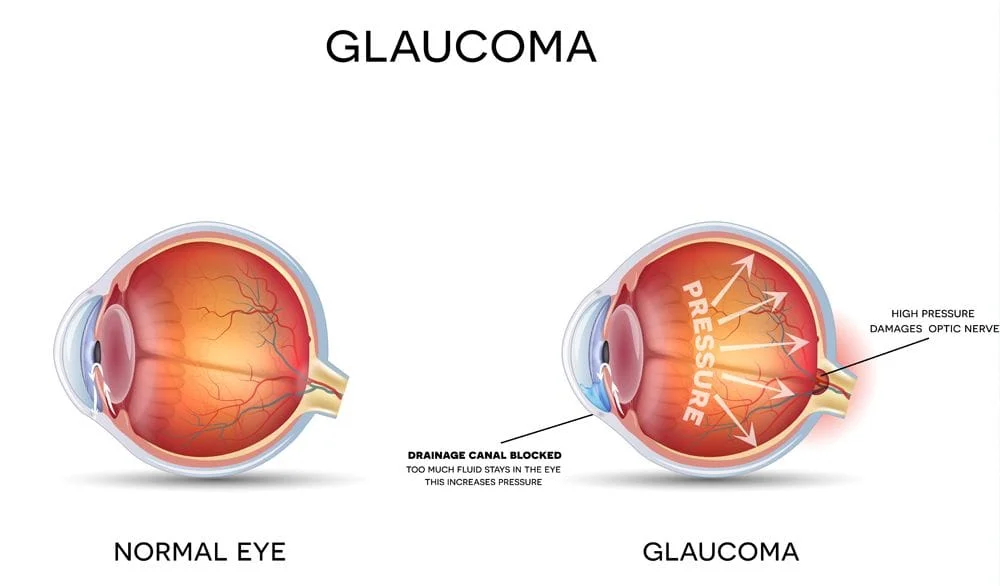 diagram of normal eye vs eye with glaucoma showing increased pressure and drainage canal blocked