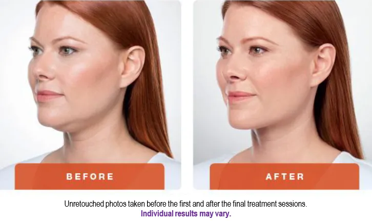 Kybella Before and After Treatment Photo