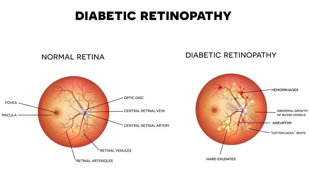Diabetic retinopathy chart