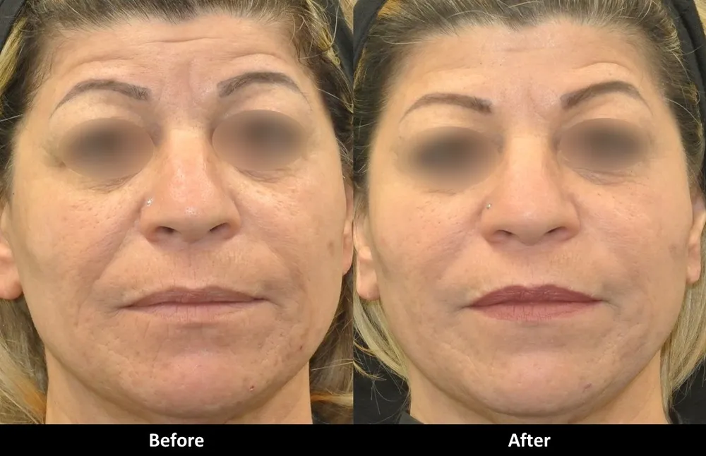 Liquid Facelift before and after