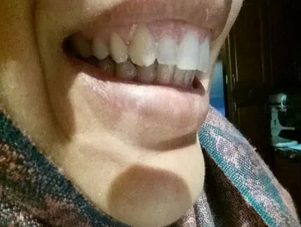 adult cosmetic braces corrected front teeth