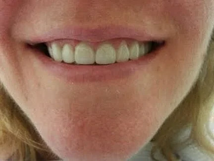 smile makeover with all porcelain crowns