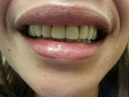 crowns placed on two front teeth