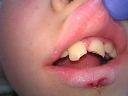 Teeth fractured in a boating accident