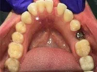 gaps in front teeth