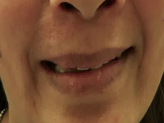 Patient did not like to smile due to front teeth