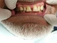 gaps and severely worn teeth