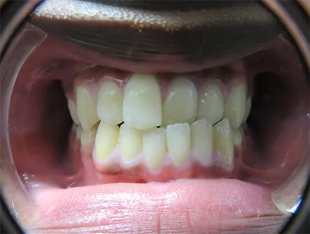 Teeth are in crossbite