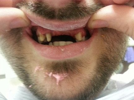 patient lost teeth in a biking accident