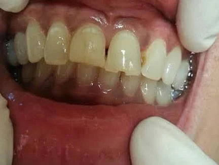 large filling was discolored and tooth broken