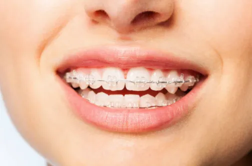 ceramicbraces