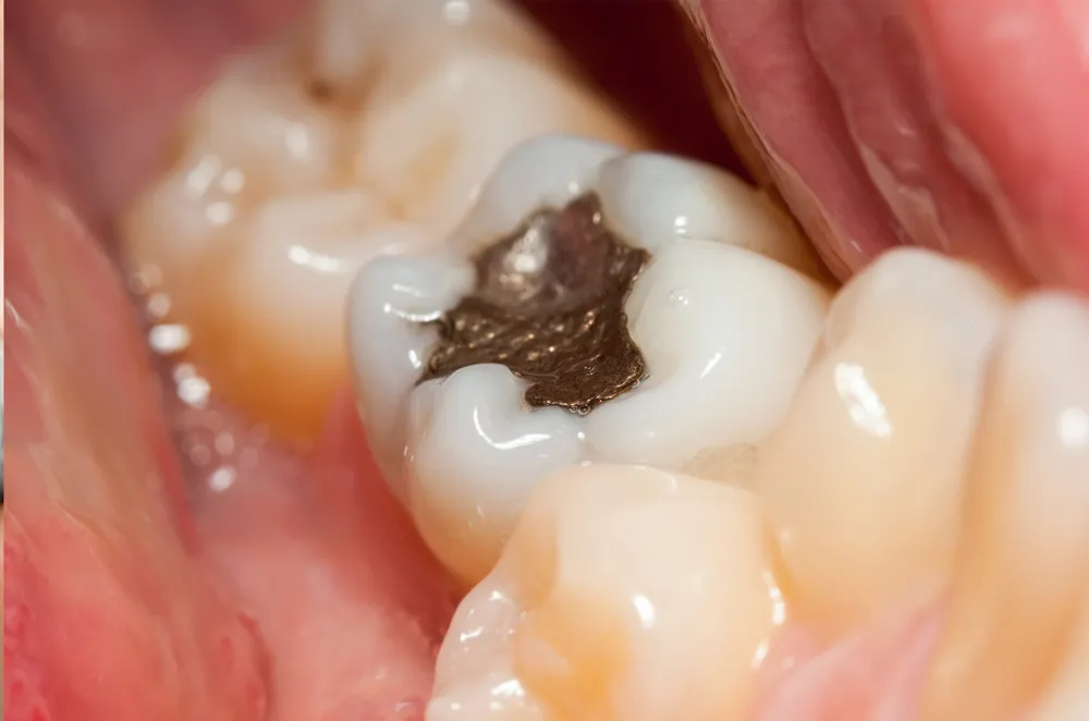 close up of teeth with metal filling Cedar City, UT composite tooth colored fillings