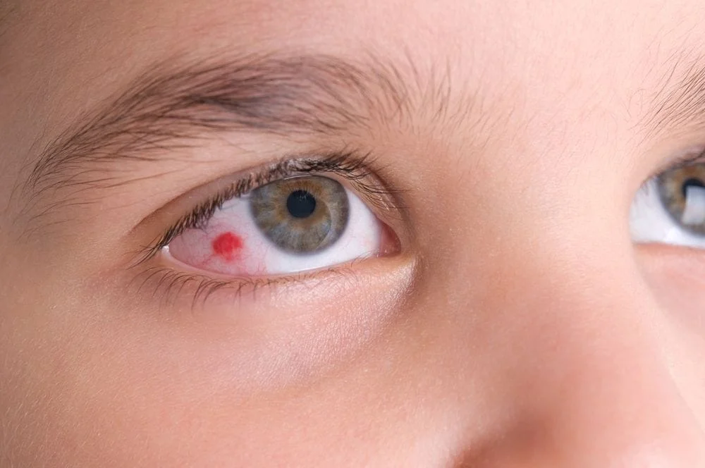 Boy with a burst blood vessel needs to see an eye doctor.