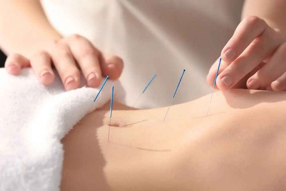 Woman getting acupuncture for infertility