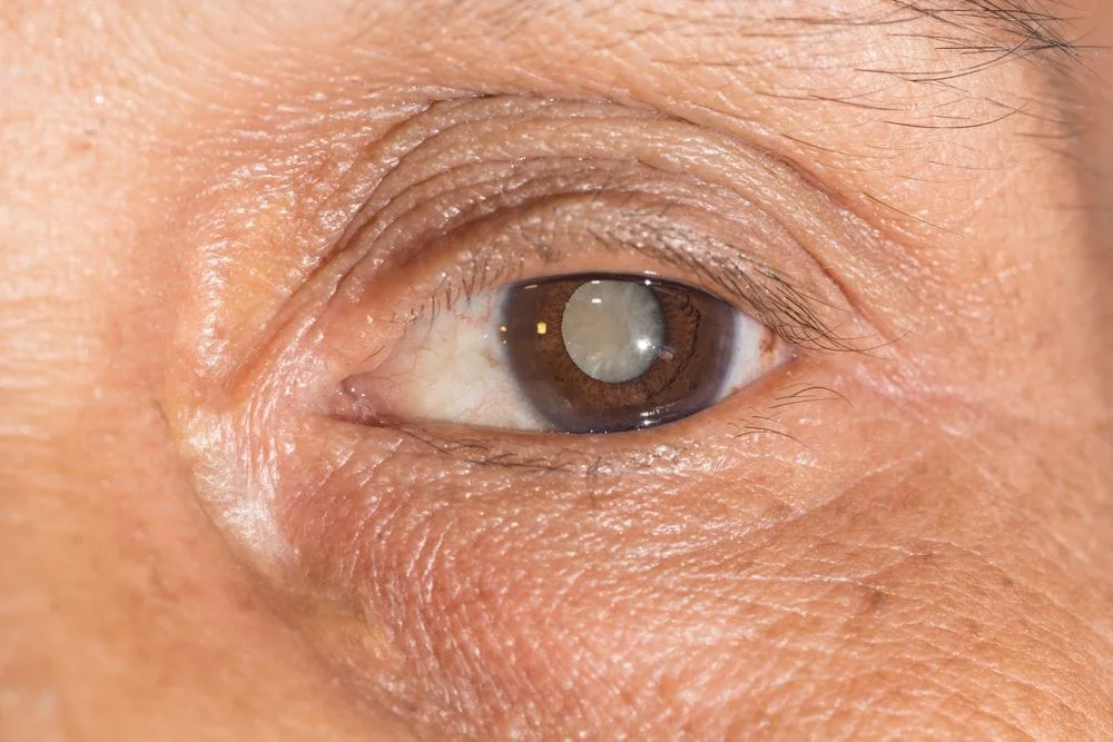 senior with cataract in eye