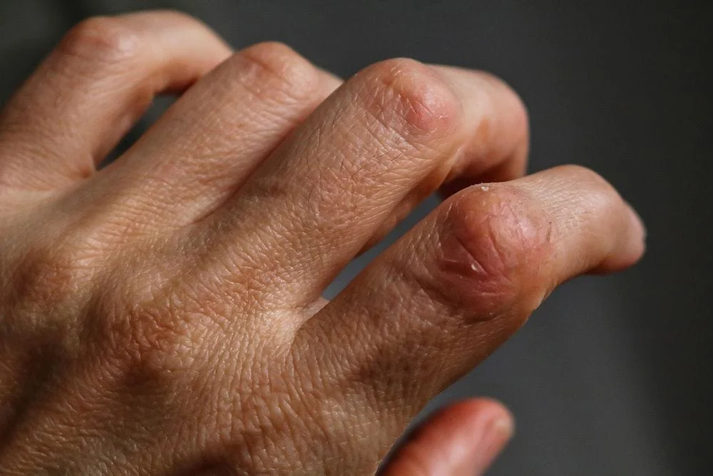 hand closeup with arthiritis