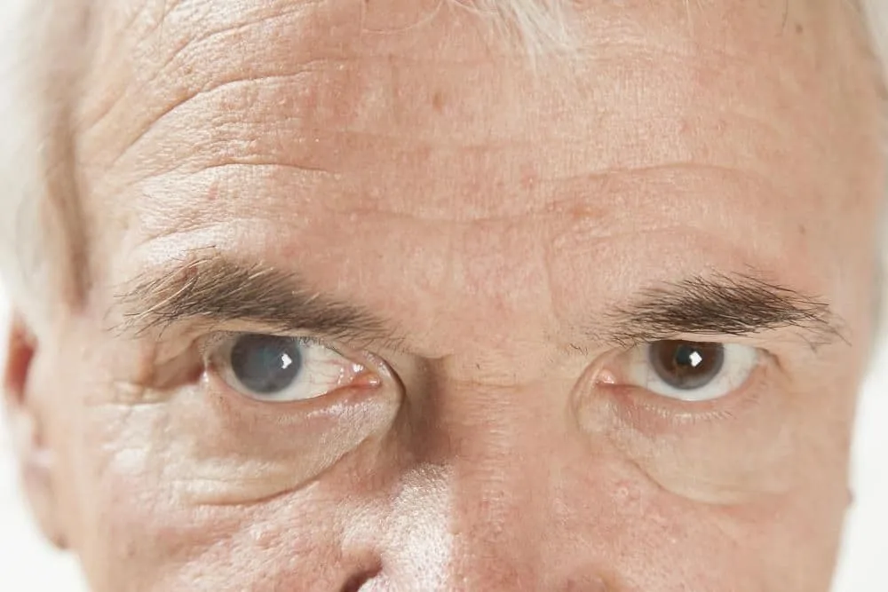 Man experiencing cataracts in his left eye