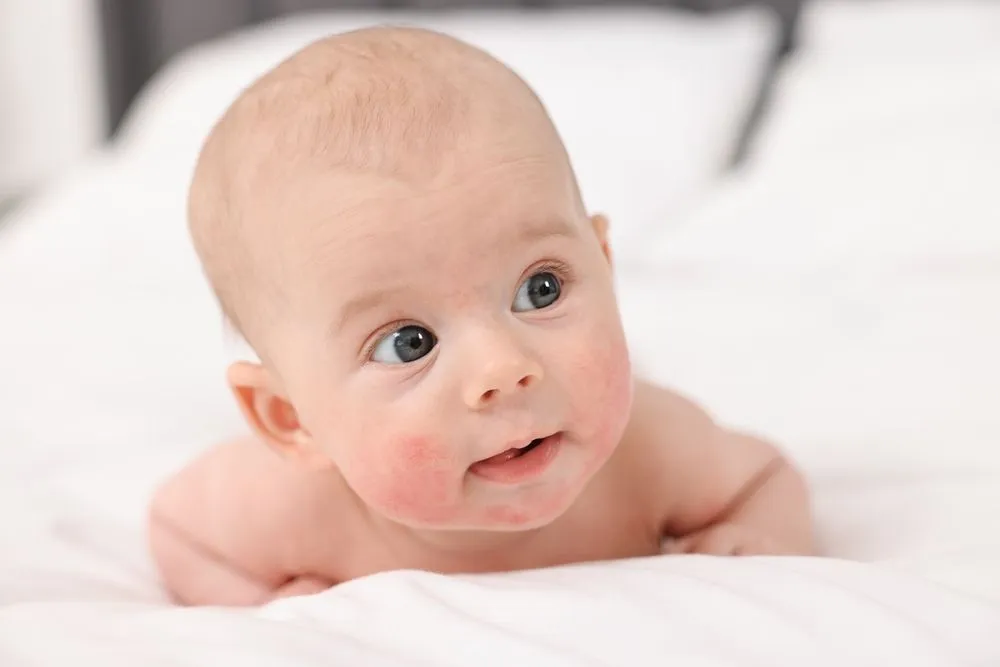 baby eczema