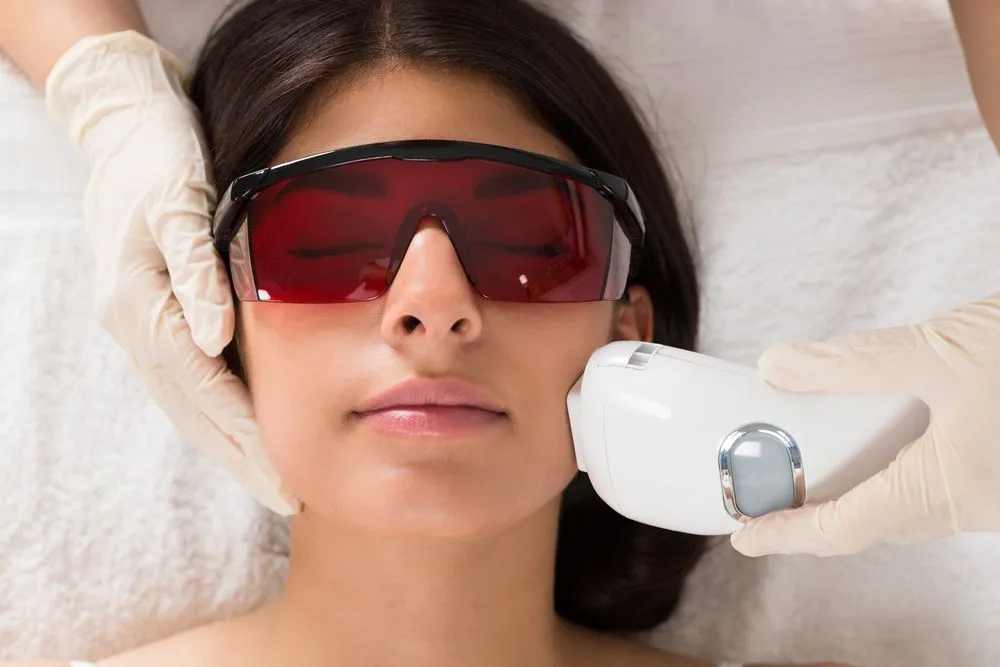 What is an IPL Photofacial?