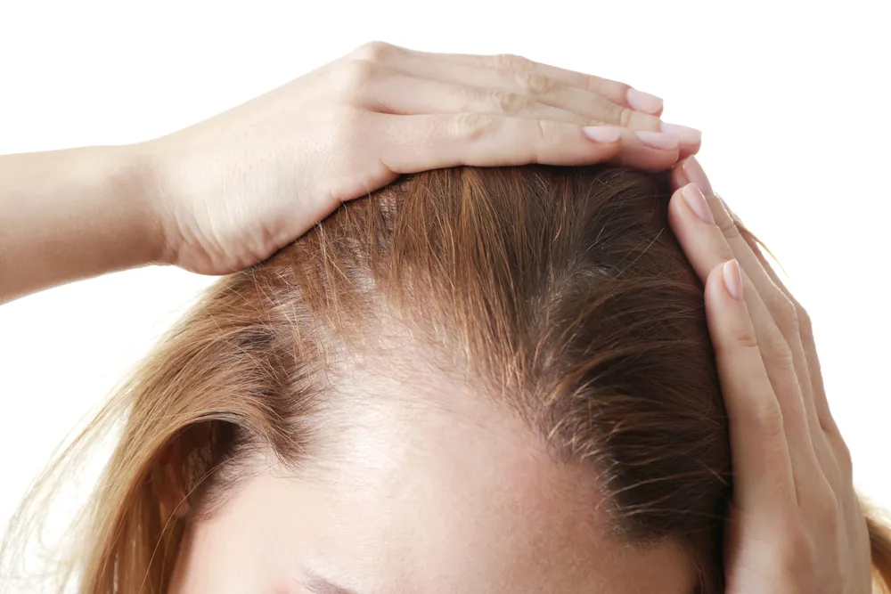 What is PRP Hair Restoration?