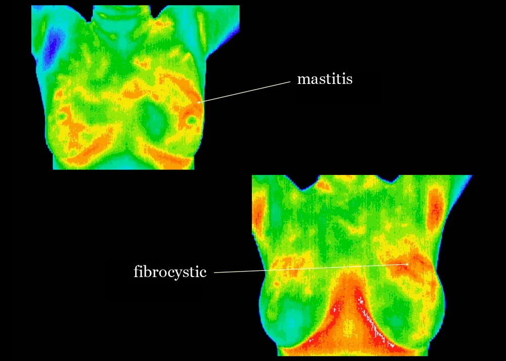Thermography is a noninvasive, no contact or radiation, clinical