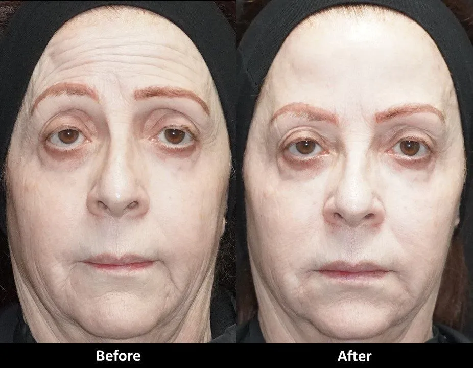 Liquid Facelift before and after