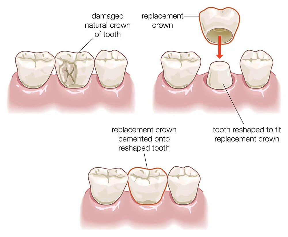 crowns