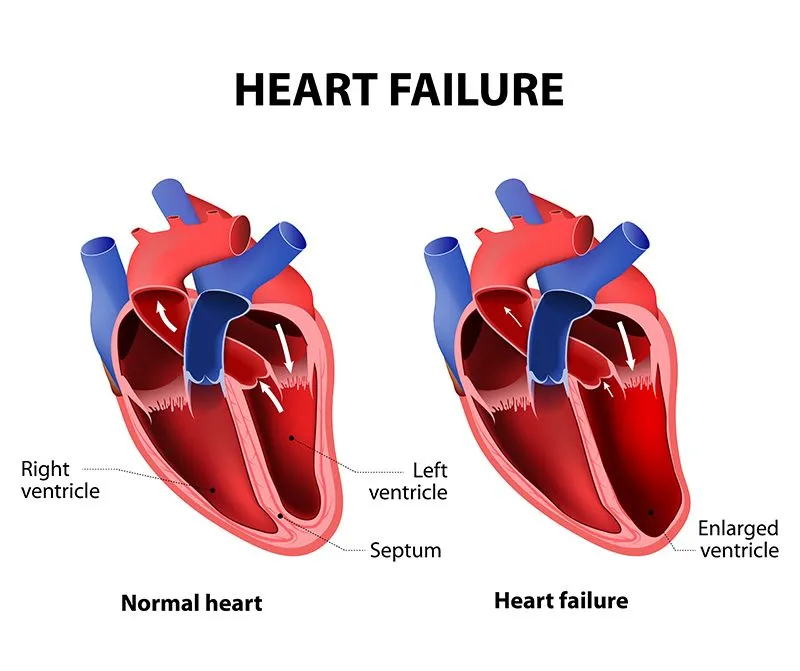 Side-by-side illustration of healthy heart versus heart with congestive heart failure.