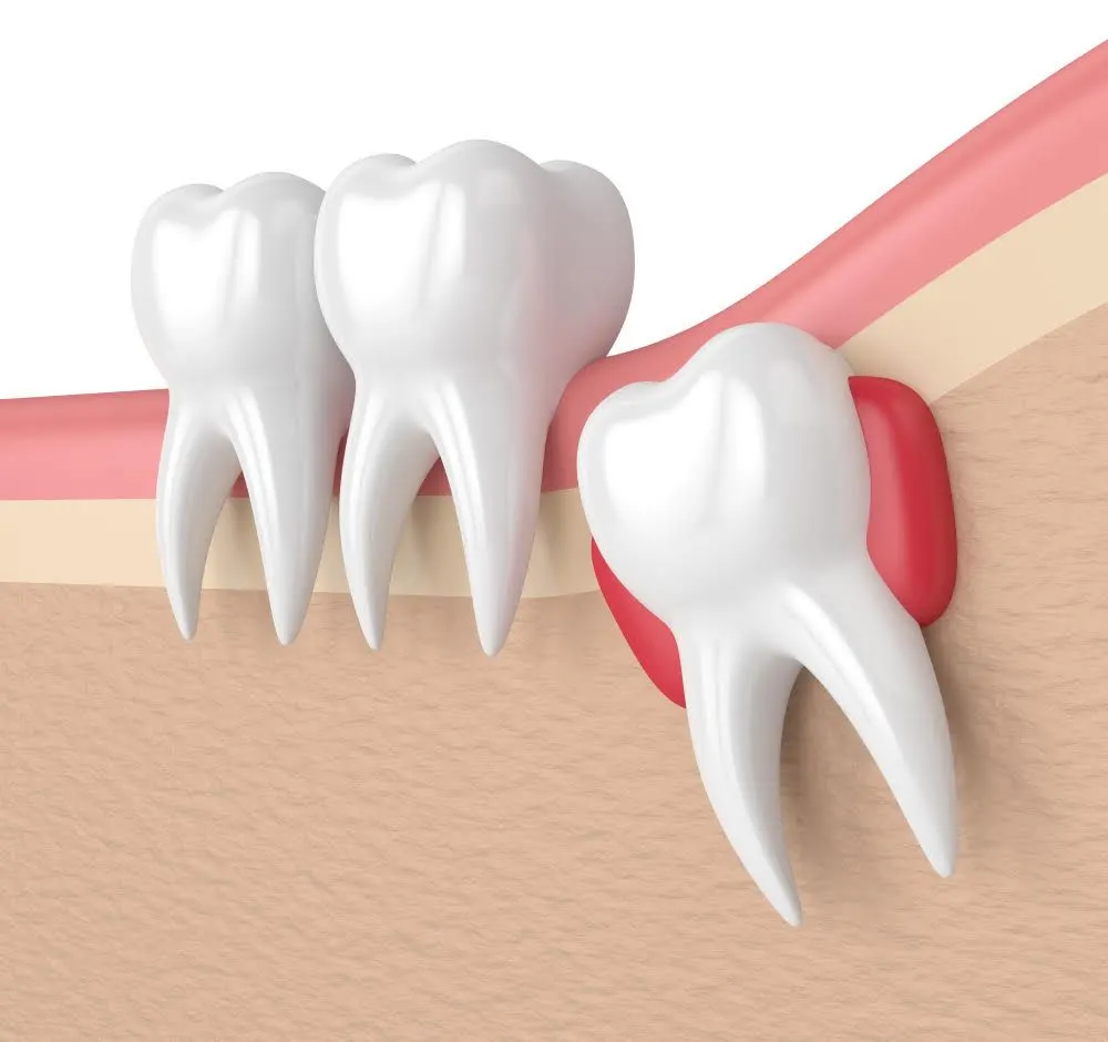 cartoon of an impacted wisdom tooth