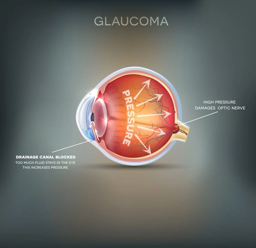 Common Symptoms of Glaucoma | Ophthalmologist in San Antonio & Floresville
