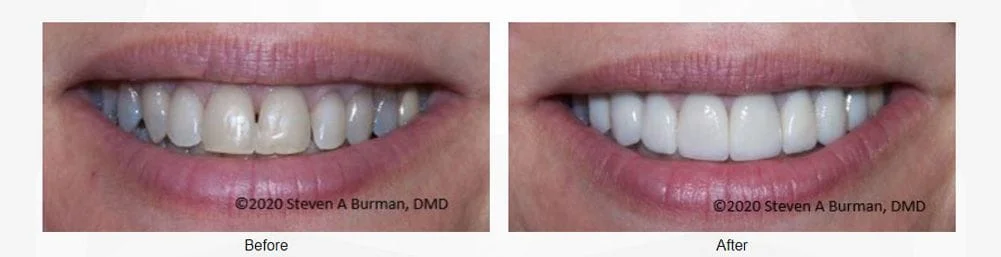 Discolored Tooth Filling  Annapolis Specialist for Restoring Your