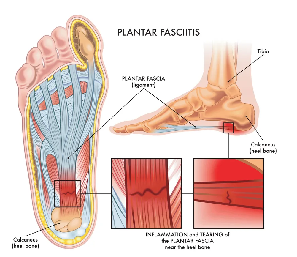 Plantar fasciitis involves the connective tissue
