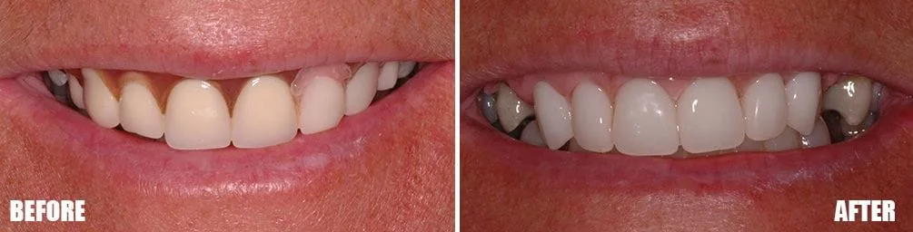 Dentures & Partials