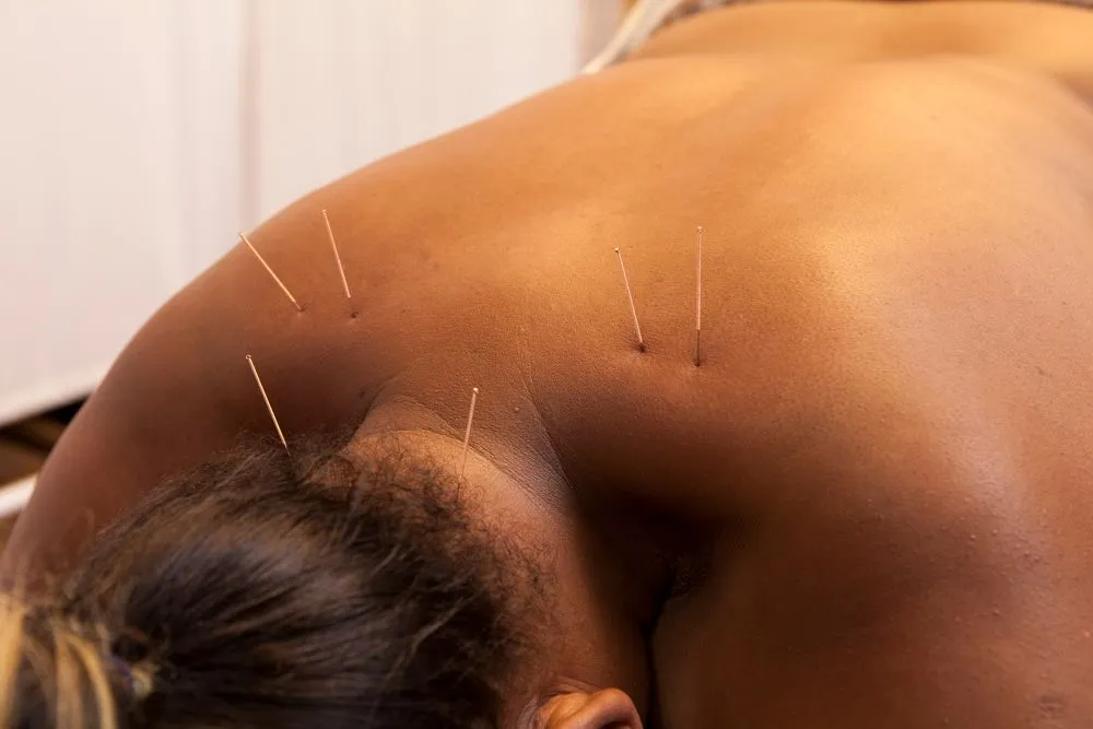 dry needling