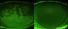 Staining on cornea before/after