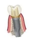 Dental Implants in Bradford