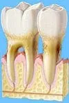 advanced_periodontitis.jpg