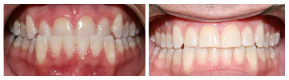 before and after images of mouth and teeth after using clear aligners Invisalign Westminster, MD dentist