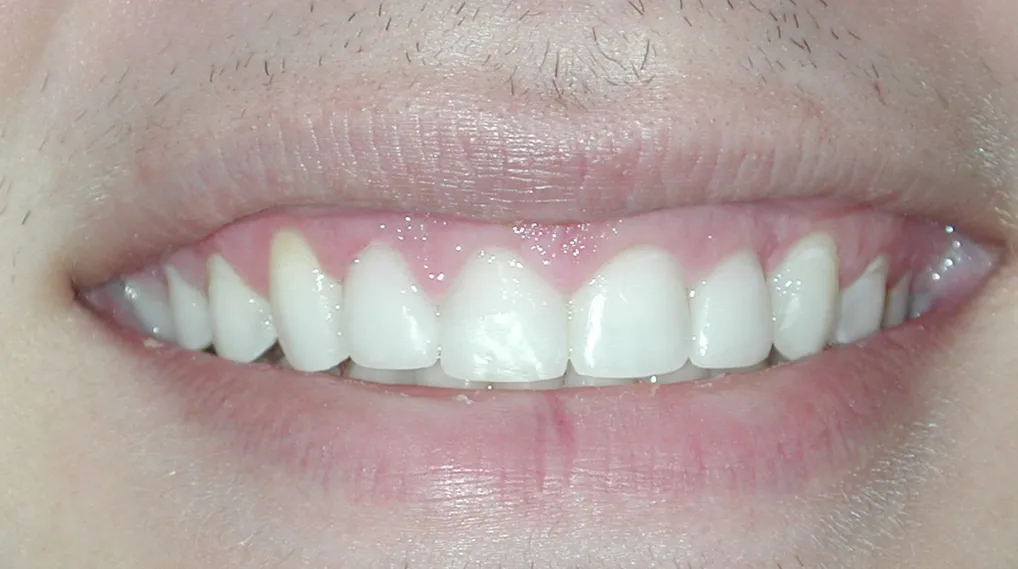 Orthodontic Gums after