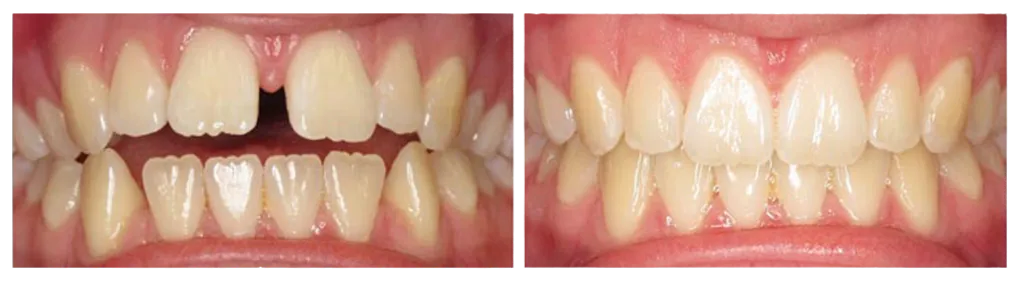 before and after image of gapped teeth corrected with clear aligner treatment, Invisalign Westminster, MD family dentist
