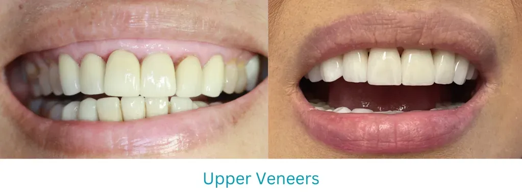 VENEER