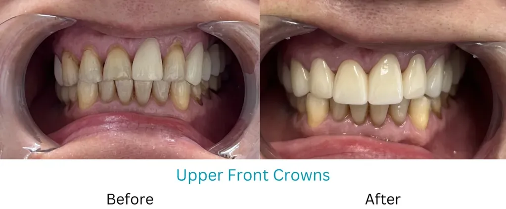 FRONT CROWNS
