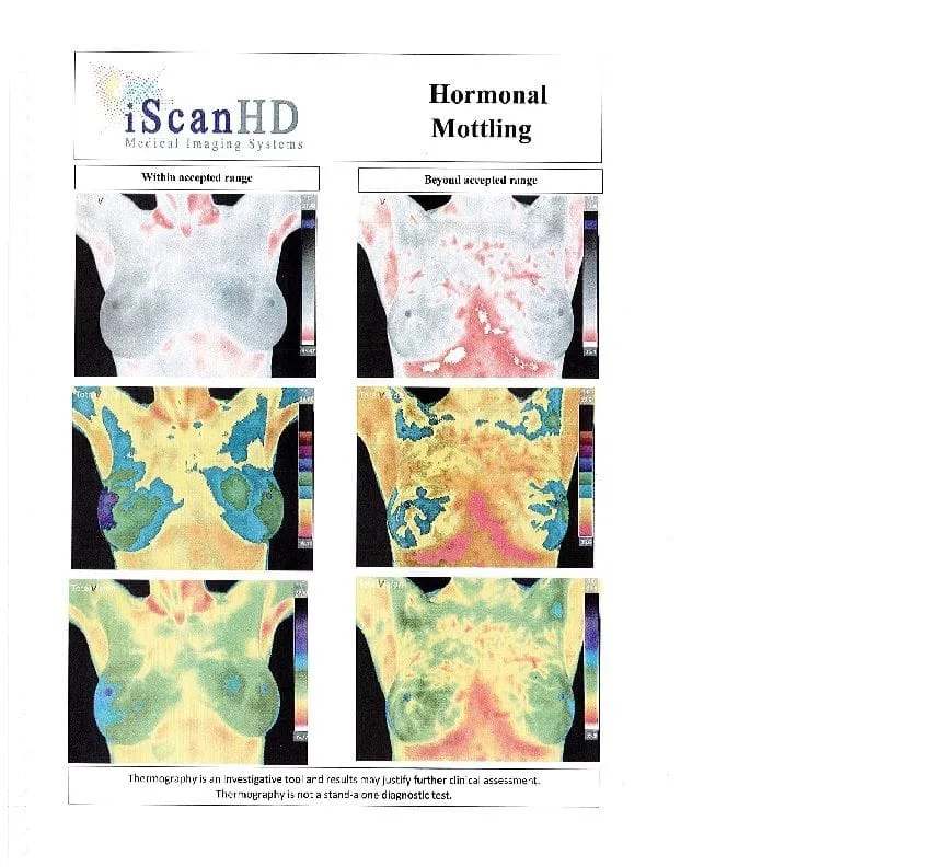 Thermography -- Hormonal Mottling