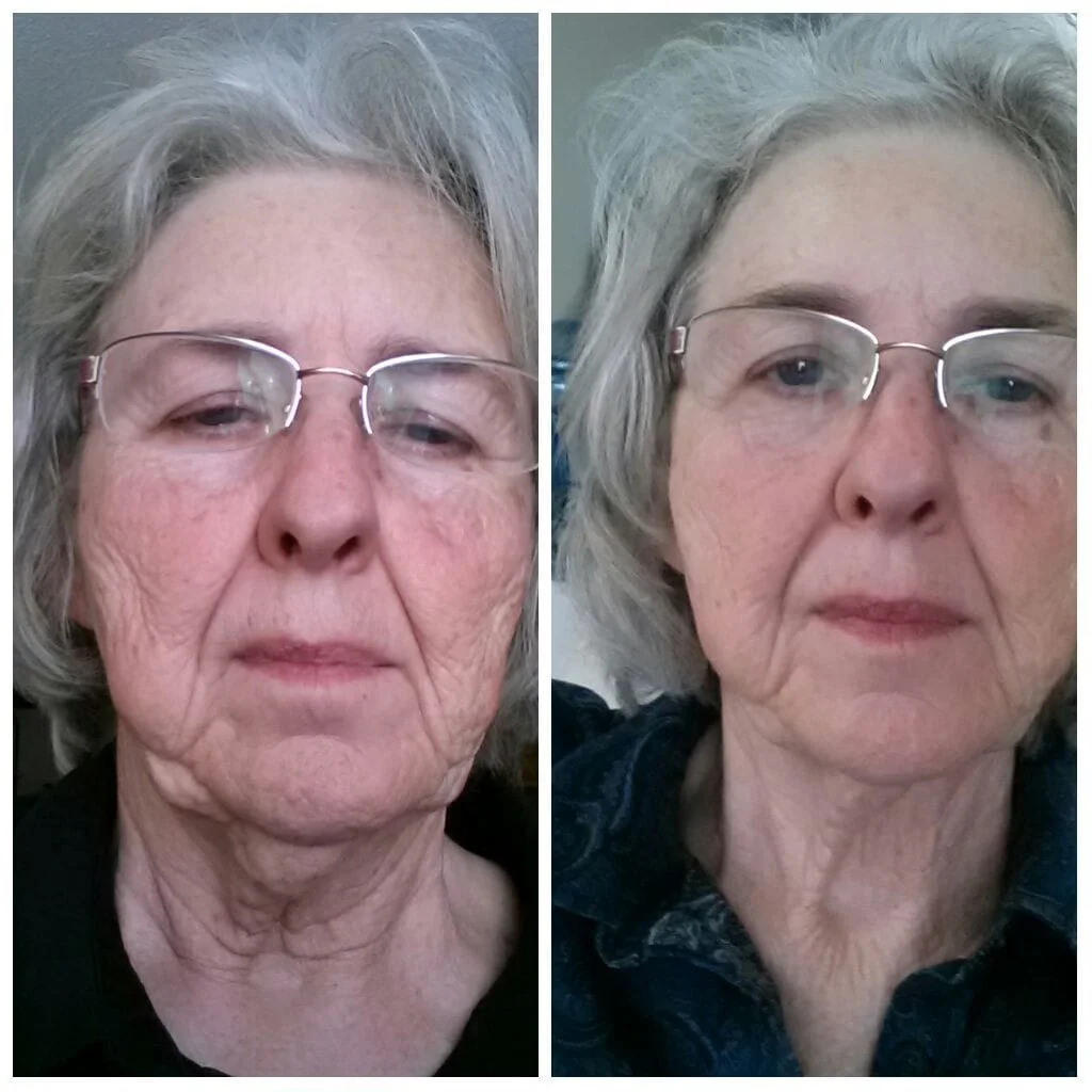 NonSurgical Facelift
