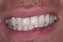 After Bonding Repair of Teeth Fracture