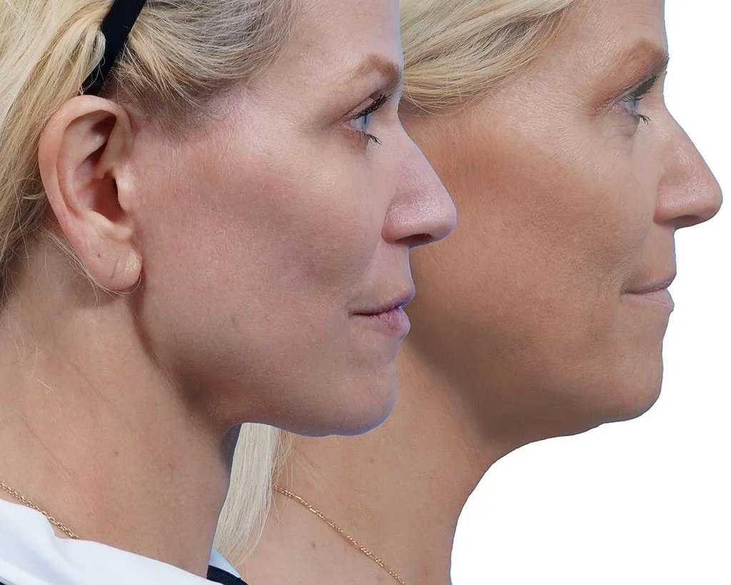 Neck lift surgery results before and after image of a woman.
